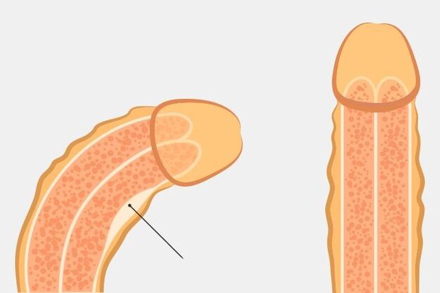 Effective way to straighten the penis